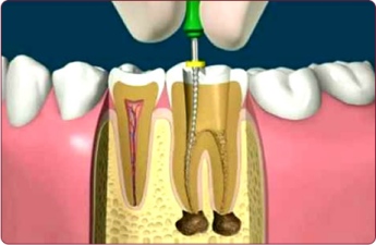 Endodonzia